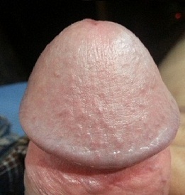 Photo of an enlarged vaginal penis