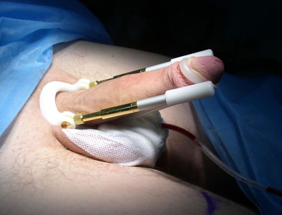 after prolonging penis enlargement surgery