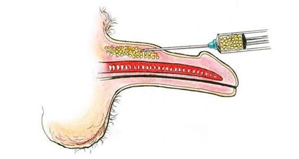 muscle tissue transplantation to enlarge the penis